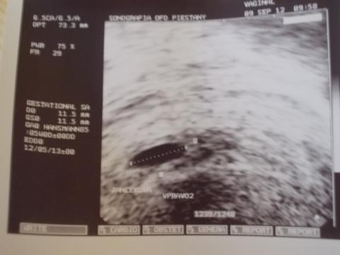 Gestačný vak Gestačný vak