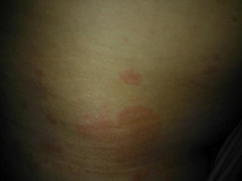 Svědivá vyrážka v 7 týdnu. Svědivá vyrážka v 7 týdnu.