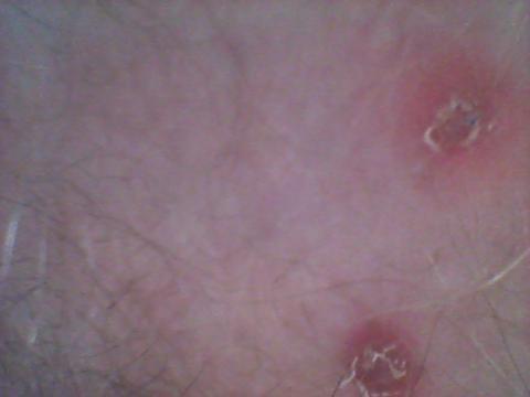 Vyrážka v slabinách